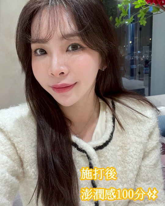 玻尿酸施打過程分享：精準與細心美學｜見證案例-Nikki